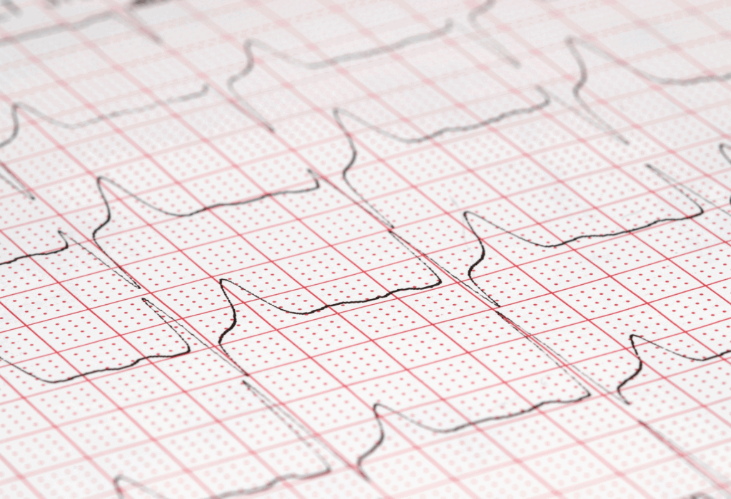ECG e Holter ECG.pn